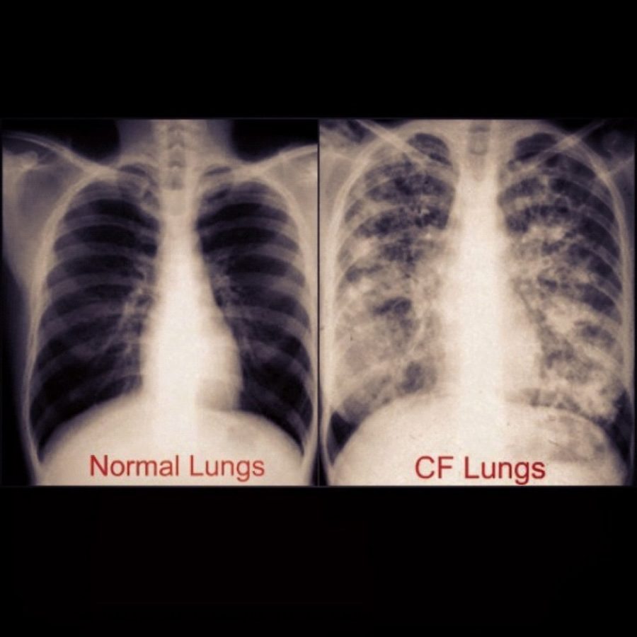 An X-ray shows differences between healthy set of lungs on the left and lungs with cystic fibrosis on the right and the damage it causes to them. 